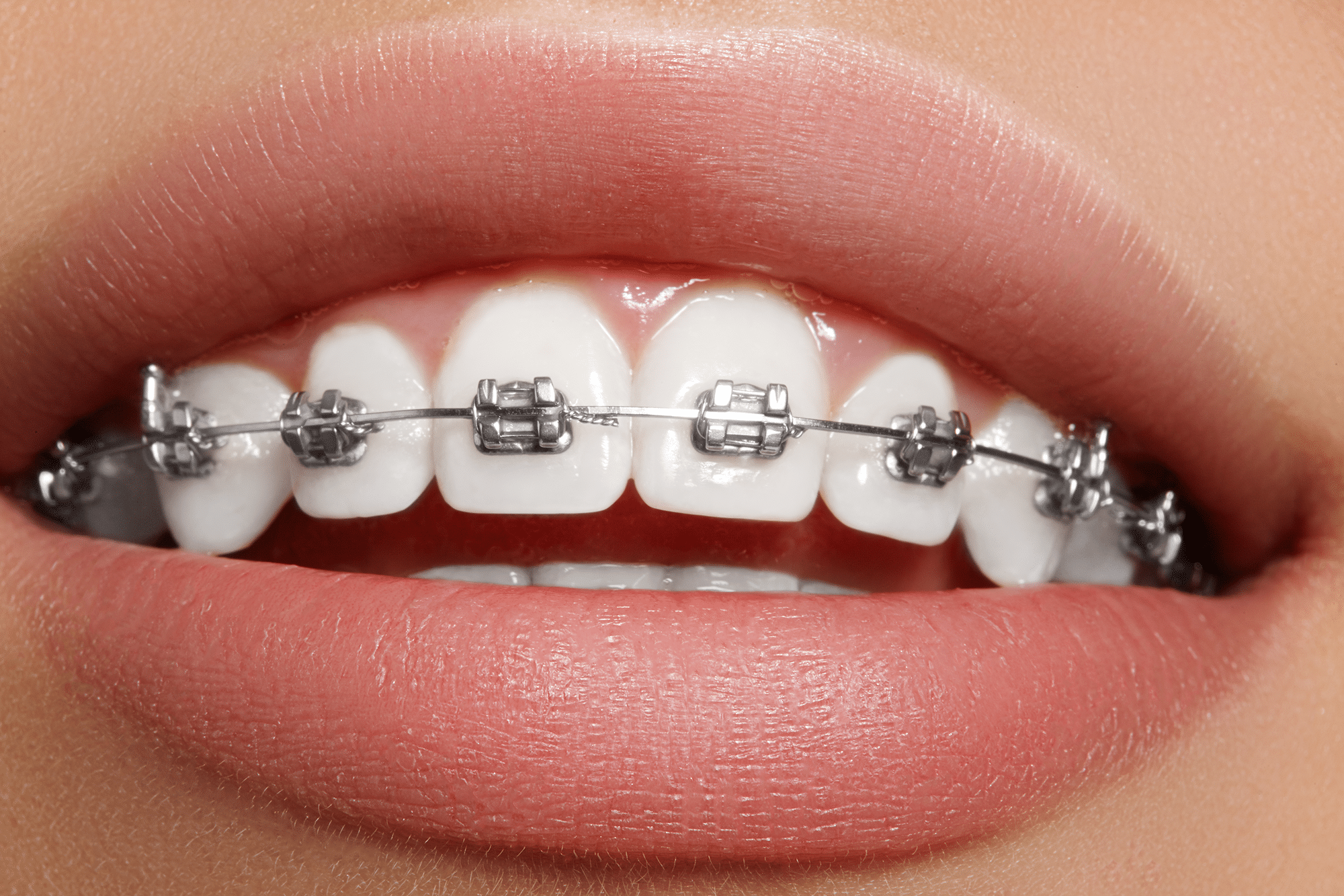 Traditional Braces for Adults